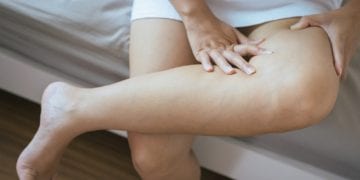 8 Methods of Prevention DVT (Deep Vein Thrombosis)