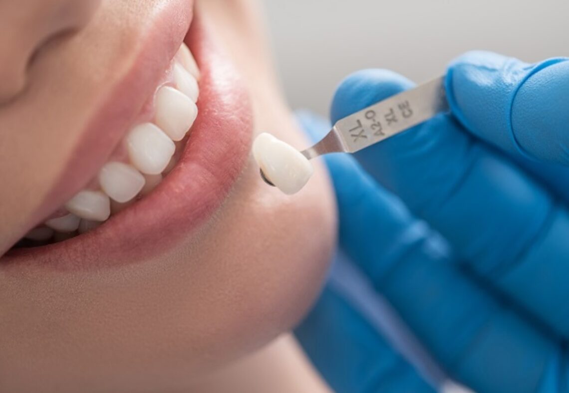10 Pros And Cons Of Dental Crown Procedures