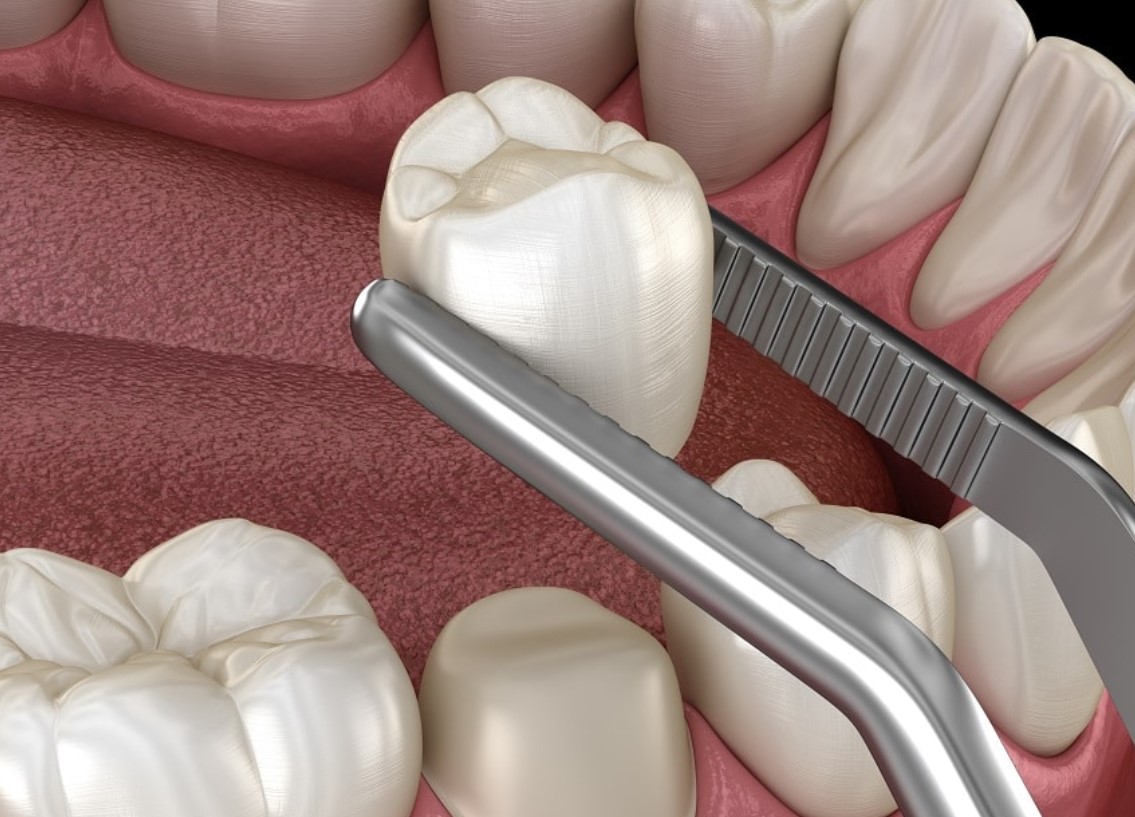 10 Pros And Cons Of Dental Crown Procedures