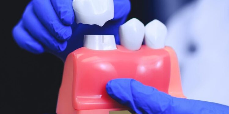 10 Pros And Cons Of Dental Crown Procedures
